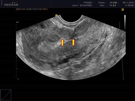 ultrasound for cesarean section